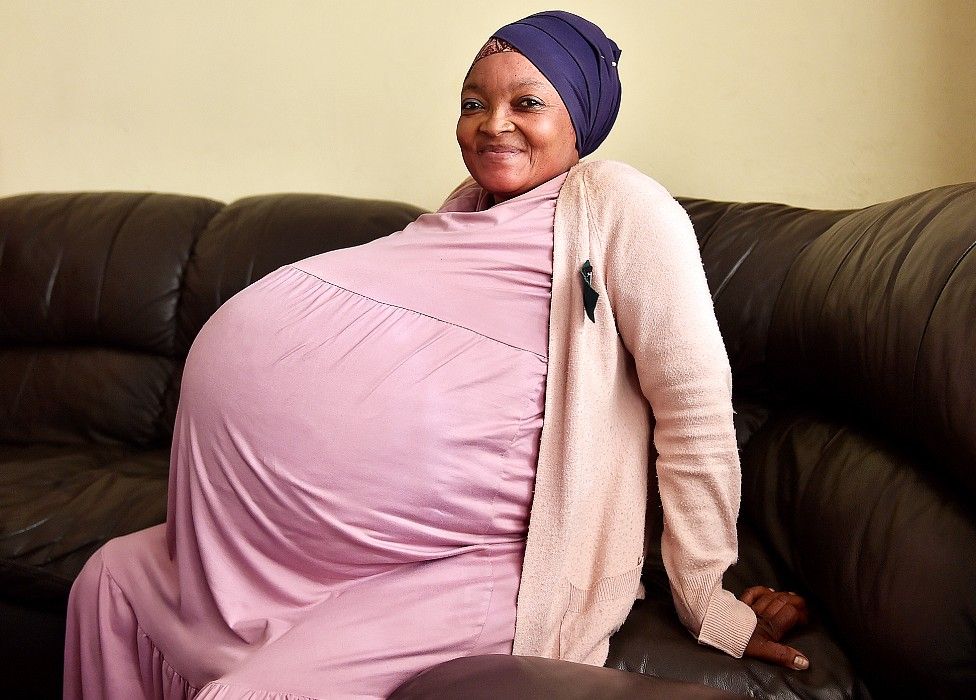南非婦女一次產下10胞胎